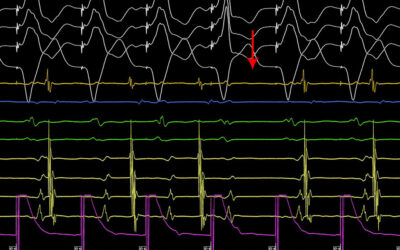 Κατάλυση Προσθιοδιαφραγματικού Δεματίου - Απόστολος Κατσίβας - Καρδιολόγος - Άρθρο Κατάλυση Προσθιοδιαφραγματικού Δεματίου - Απόστολος Κατσίβας - Καρδιολόγος - Άρθρο