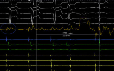Κατάλυση Ασθενής - δεξιοκαρδία - ολική αναστροφή σπλάχνων - Απόστολος Κατσίβας - Καρδιολόγος Αθήνα Κατάλυση Ασθενής - δεξιοκαρδία - ολική αναστροφή σπλάχνων - Απόστολος Κατσίβας - Καρδιολόγος Αθήνα