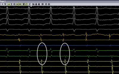 Ταχυκαρδία με μακρό RP - Διάγνωση και κατάλυση - Απόστολος Κατσίβας - Καρδιολόγος Αθήνα Ταχυκαρδία με μακρό RP - Διάγνωση και κατάλυση - Απόστολος Κατσίβας - Καρδιολόγος Αθήνα